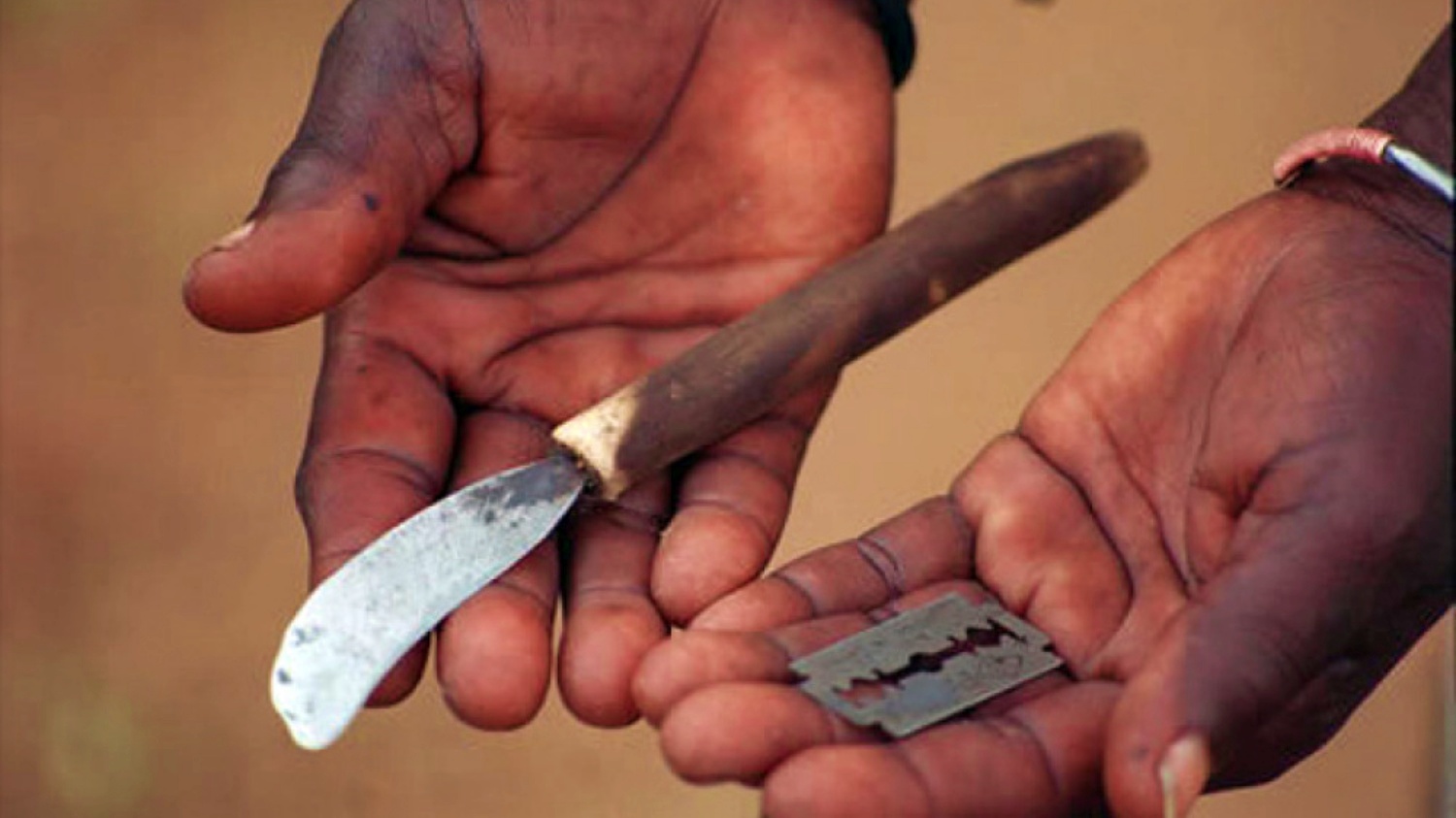 Mutilación genital femenina