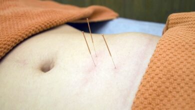 Una mujer recibe acupuntura en Albacete