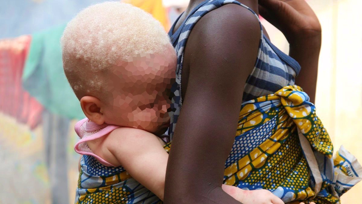 Un niño albino en África / Creador: FLICKR - FEIJE RIEMERSMA / Imagen propiedad de: Europa Press